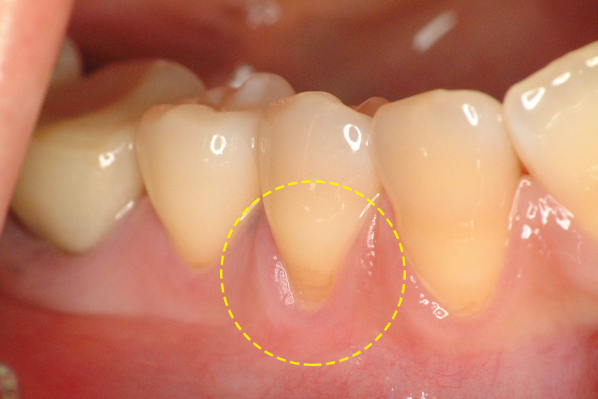 歯ぎしりによって歯ぐきが下がった状態