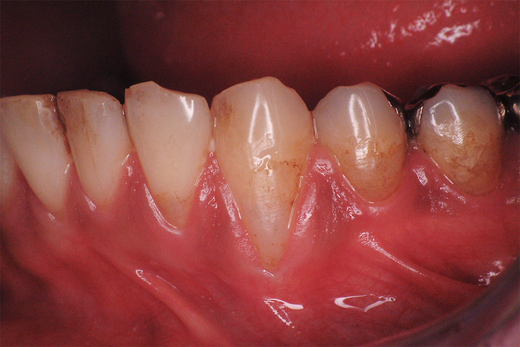 左側下顎の犬歯は歯ぐきが下がっている