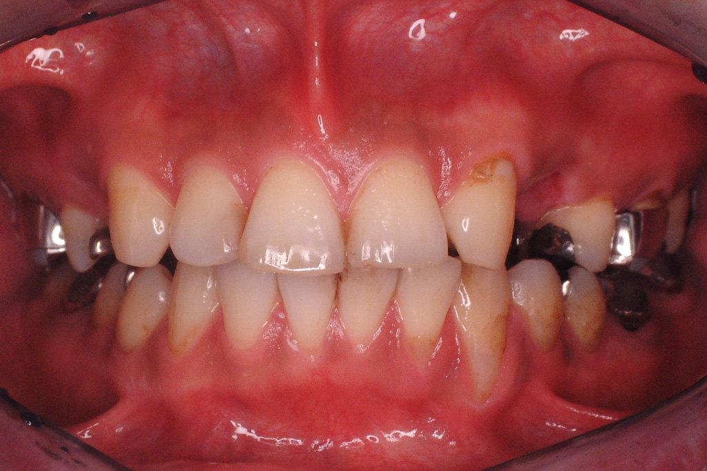 左側の側切歯がなし小臼歯部に空隙
