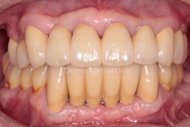 歯周病の治療とインプラントを終了した口腔正面