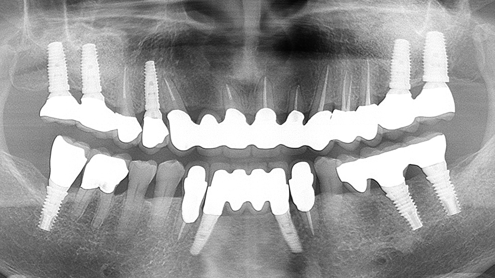 歯周病の治療とインプラントを終了した口腔X線