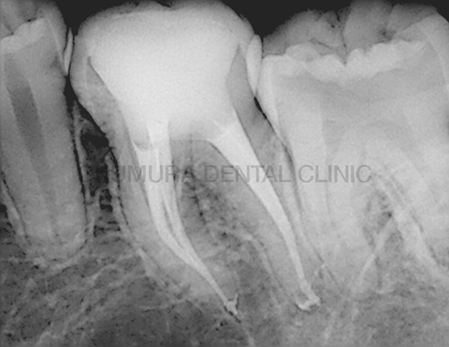 正しい根管形成のゴールを達成している根管治療症例の一部 Case1