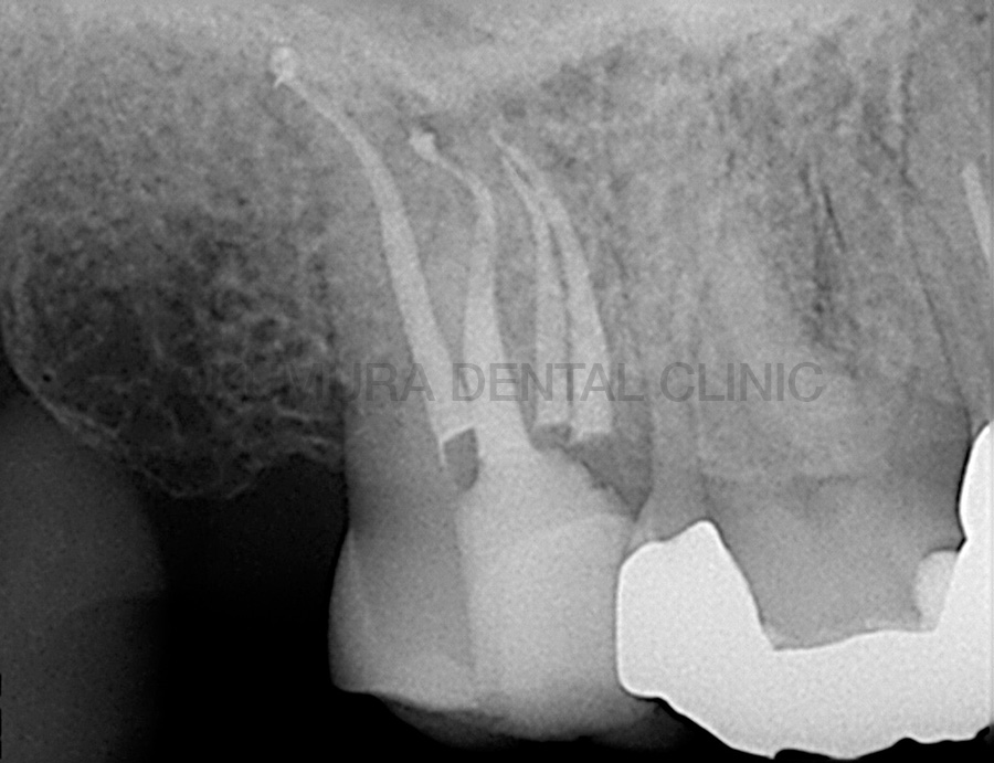 正しい根管形成のゴールを達成している根管治療症例の一部 Case2