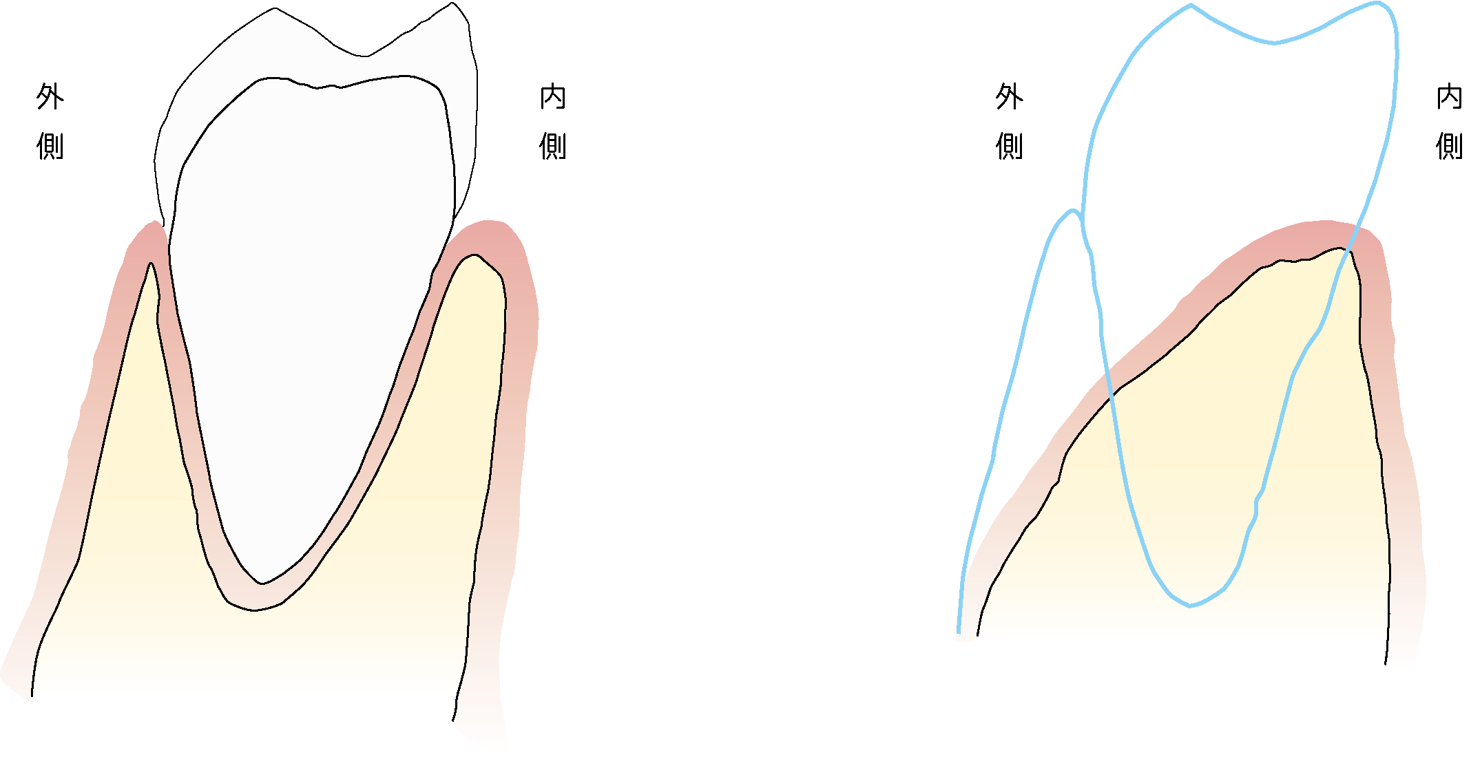 抜歯して放置すると骨がやせて歯ぐき凹む