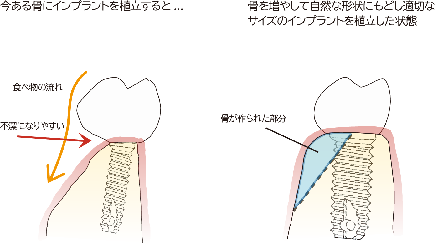 骨をつくってからインプラント埋入