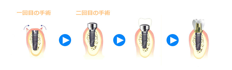 インプラント治療の基本的流れ